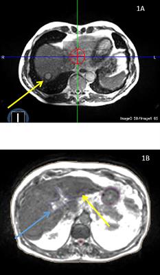 Is MRI-Linac helpful in SABR treatments for liver cancer?